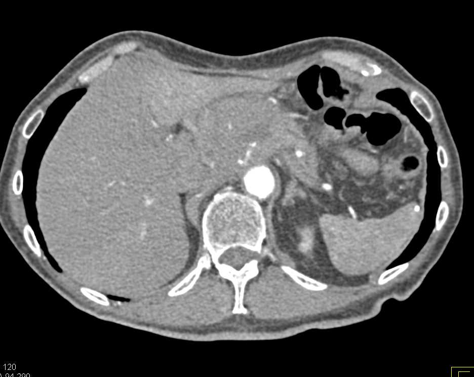 Lymphoma Simulates a Pancreatic Mass - CTisus CT Scan