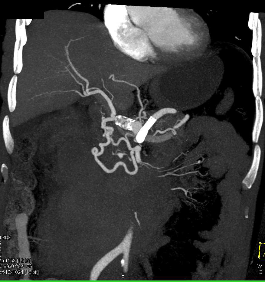 Lymphoma Infiltrates the Mesentery - CTisus CT Scan