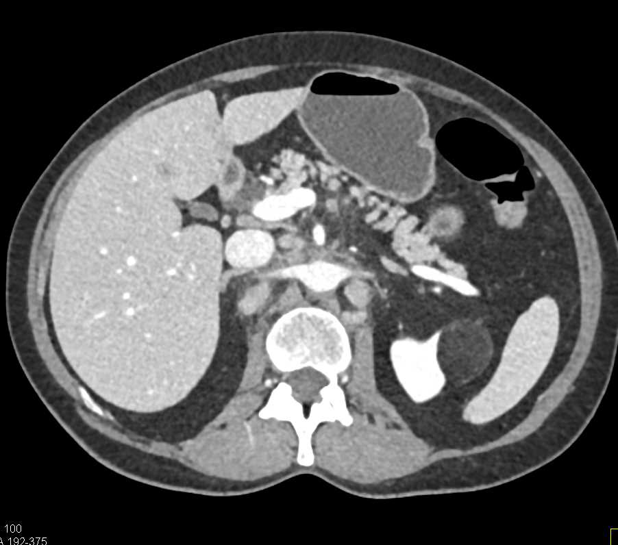 Lymphoma with Extensive Adenopathy - CTisus CT Scan