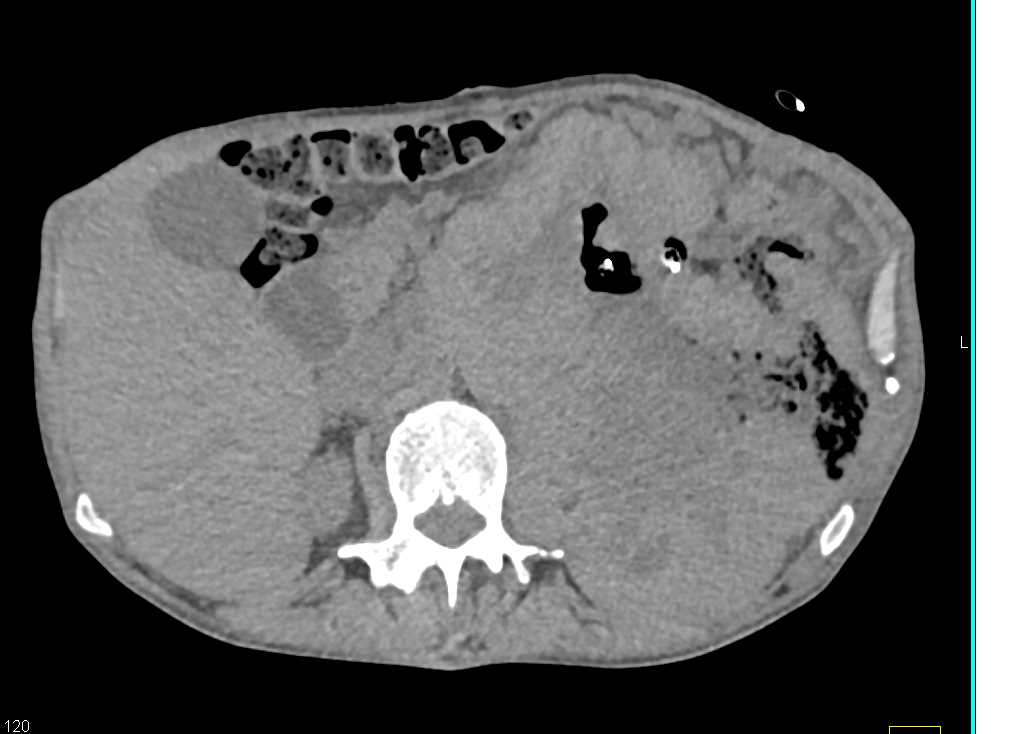 Large Necrotic Ulcerating GIST Tumor - CTisus CT Scan