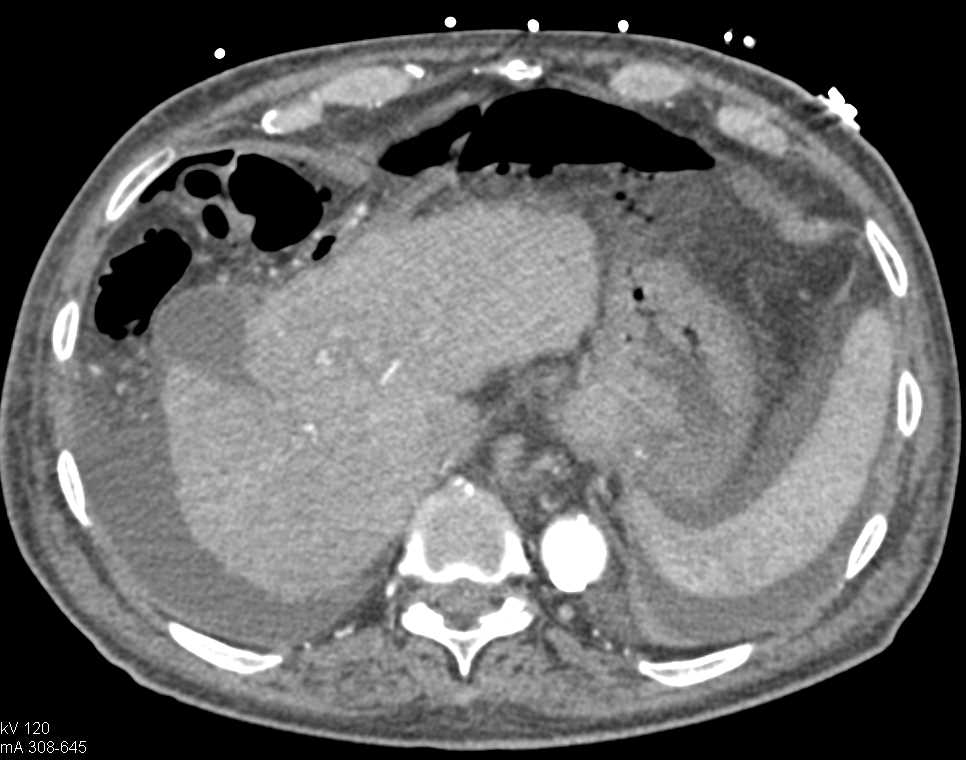 Pneumoperitoneum with Peritonitis - CTisus CT Scan