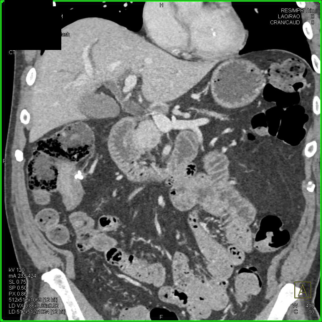 Ampullary Carcinoma with Involves Duodenum - Gastrointestinal Case ...