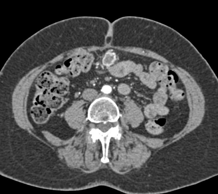 2cm Implant on the Omentum - CTisus CT Scan