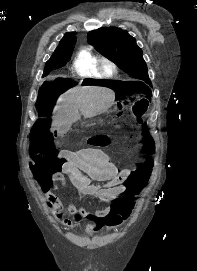 Large Pneumoperitoneum with Bowel Perforation - CTisus CT Scan