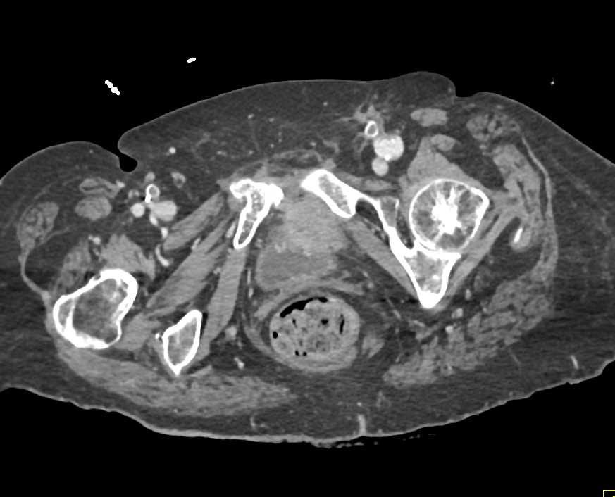 Metastatic Melanoma to Duodenum Simulates a Pancreatic Mass With Other Masses Present - CTisus CT Scan