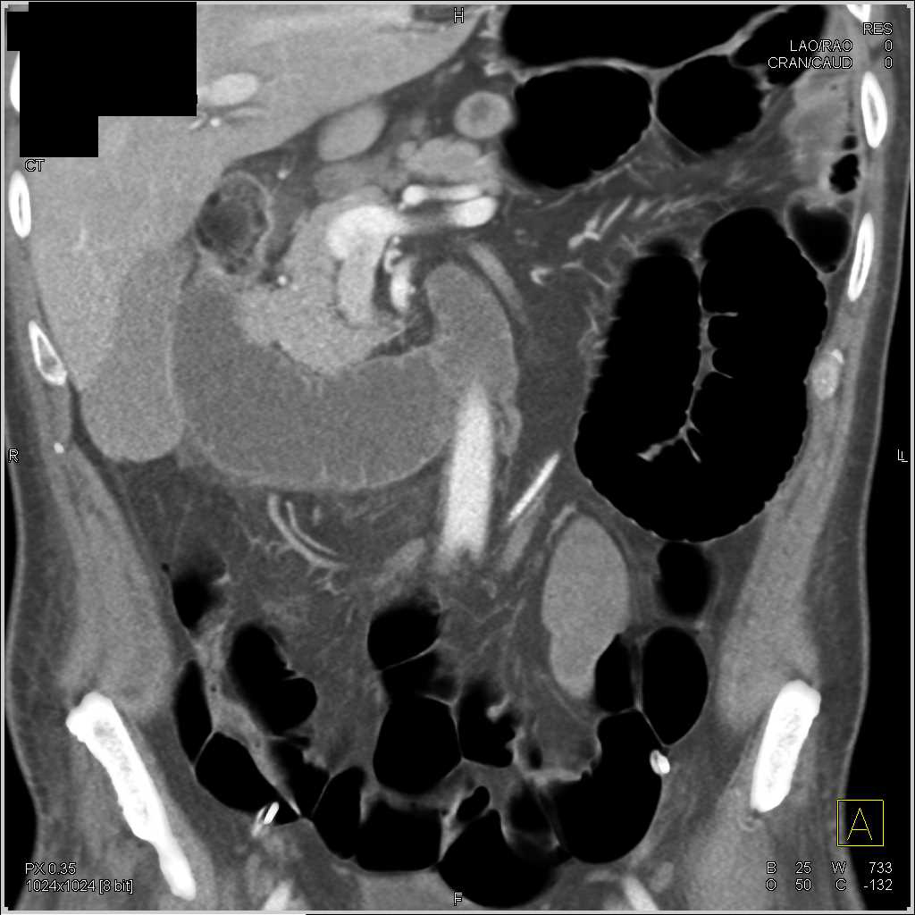 Pneumoperitoneum due to Bowel Perforation - CTisus CT Scan