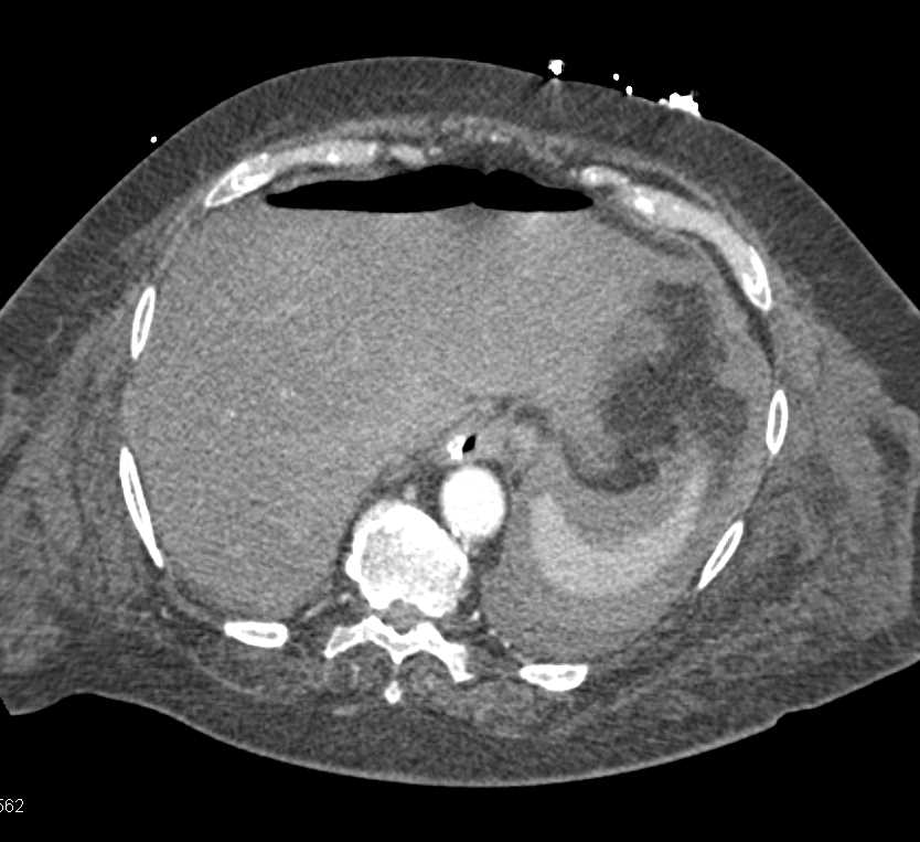 Pneumoperitoneum - CTisus CT Scan