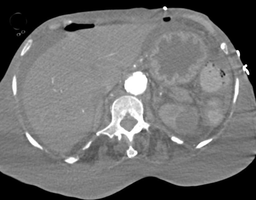 Pneumoperitoneum s/p G-Tube Placement - CTisus CT Scan