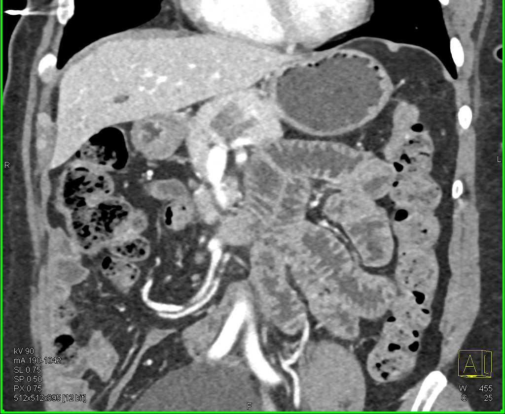 Adenocarcinoma Body of the Pancreas - CTisus CT Scan