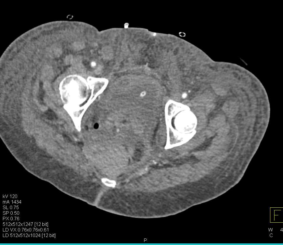 Perirectal Abscess and Anasarca - CTisus CT Scan