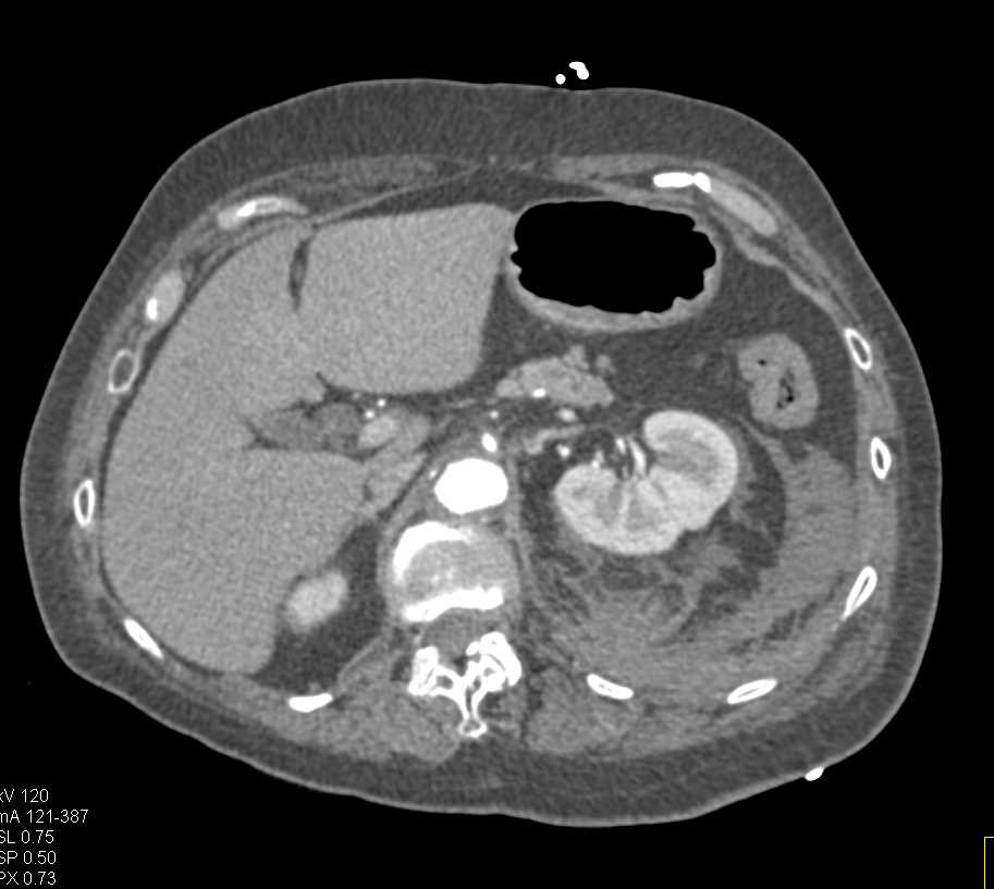 Active Bleed in the Retroperitoneum - CTisus CT Scan