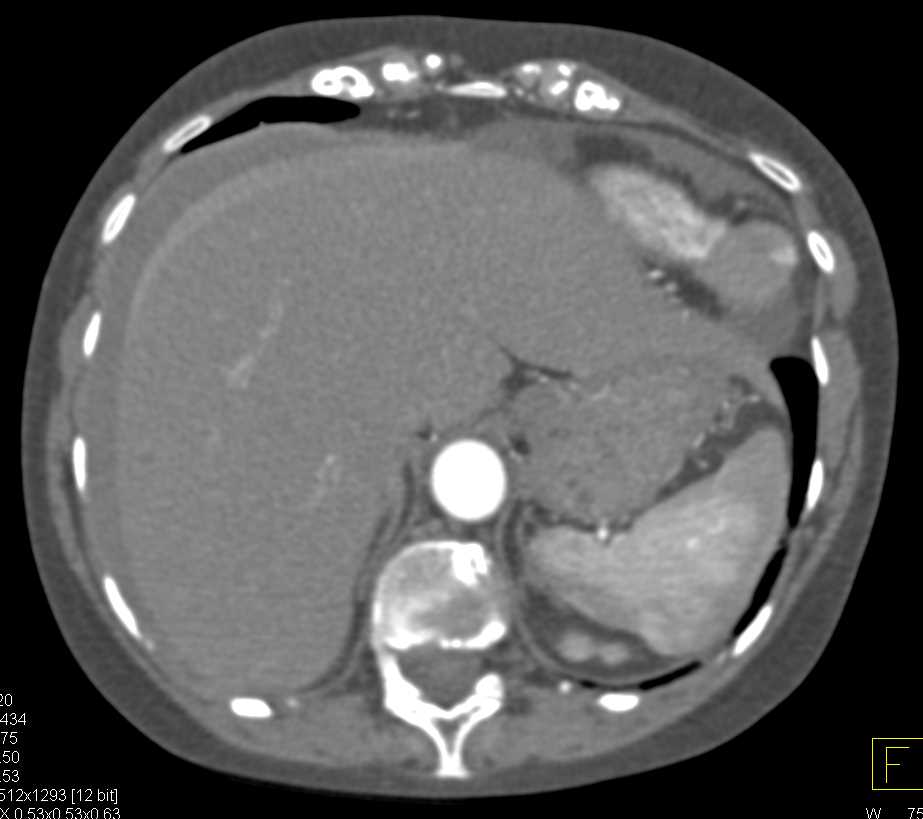 Active Bleed in the Mesentery - CTisus CT Scan