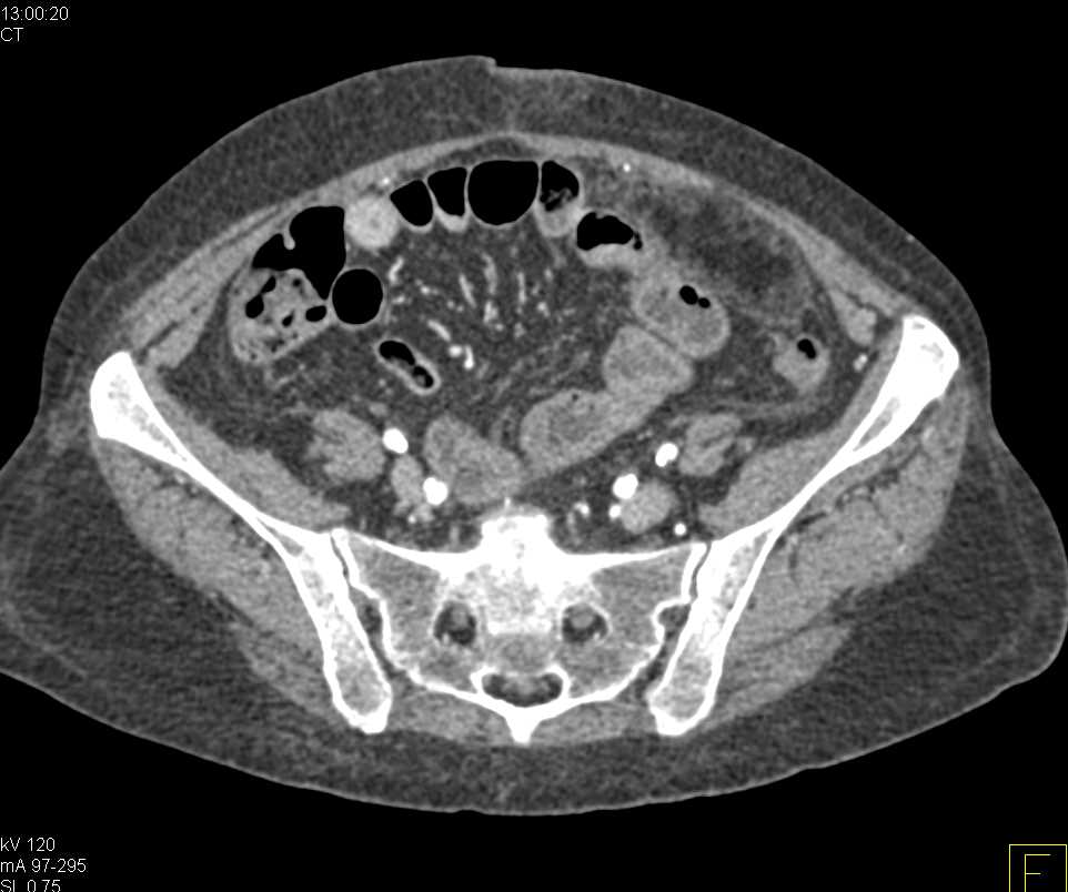 Omental Infarction Left Lower Quadrant - CTisus CT Scan