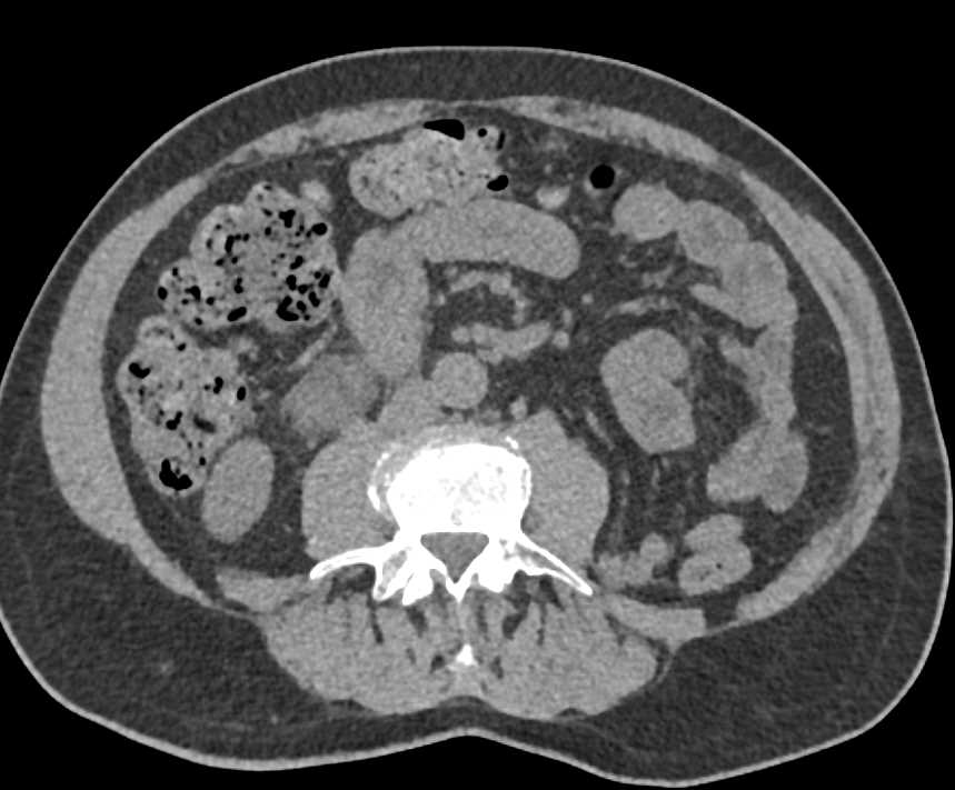 Bowel Changes S/P Left Nephrectomy - CTisus CT Scan