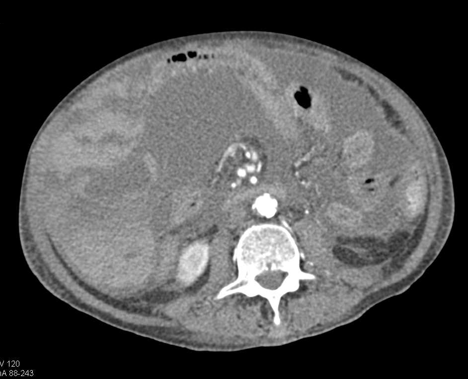 Hemoperitoneum and Ischemic Small Bowel Loops - CTisus CT Scan