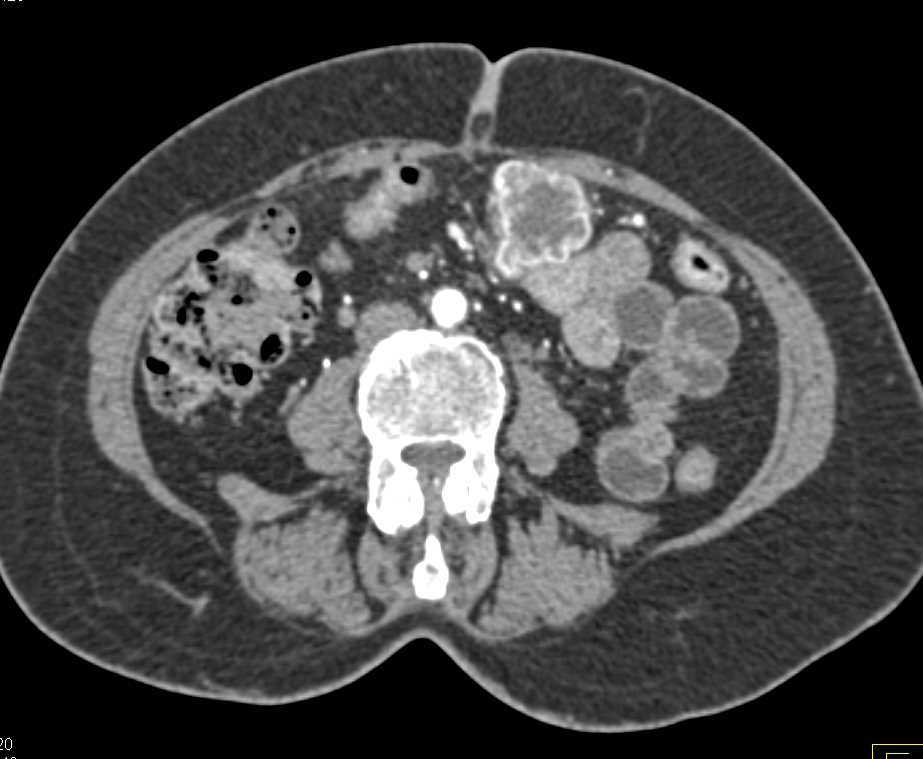 Metastatic Renal Cell Carcinoma to Bowel and Mesentery - CTisus CT Scan