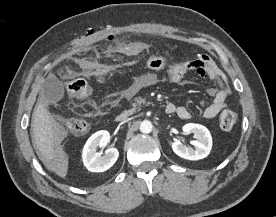 Active Bleed in Abdomen - CTisus CT Scan