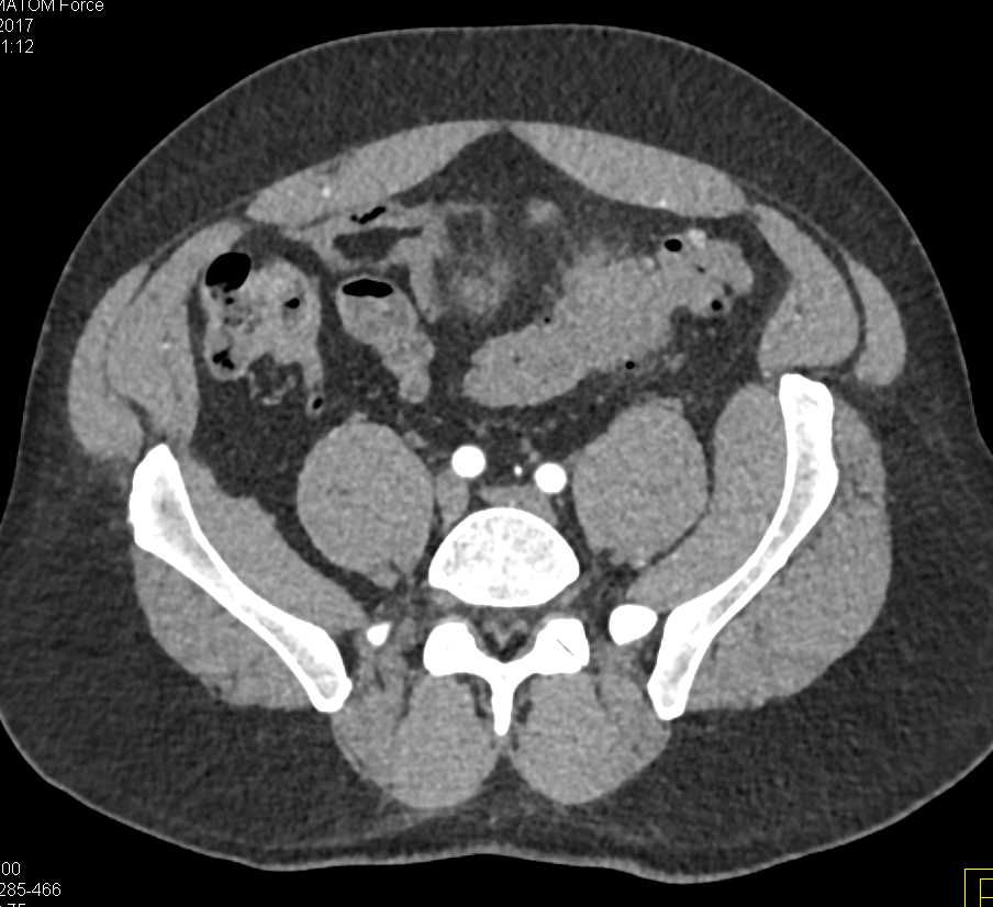 Diverticulitis Involves the Bladder - CTisus CT Scan