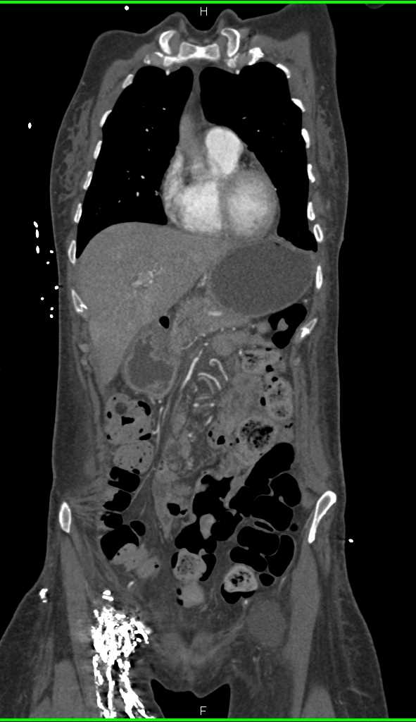 CT Findings of a Prior Lymphangiogram - CTisus CT Scan