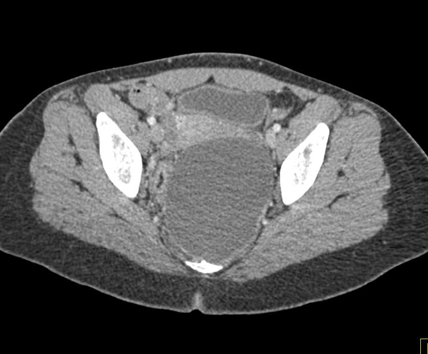 Lymphocele in the Pelvis - CTisus CT Scan