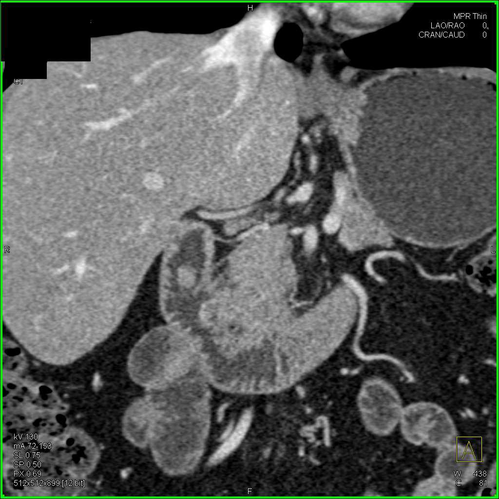 Polypoid Lesion in Duodenum - CTisus CT Scan