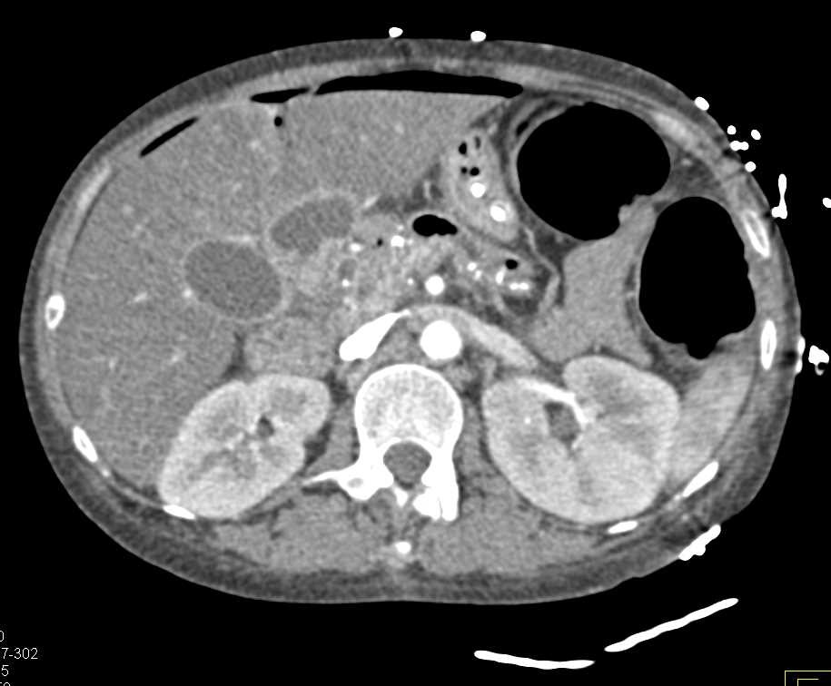 Pneumoperitoneum Following G-Tube Placement - CTisus CT Scan