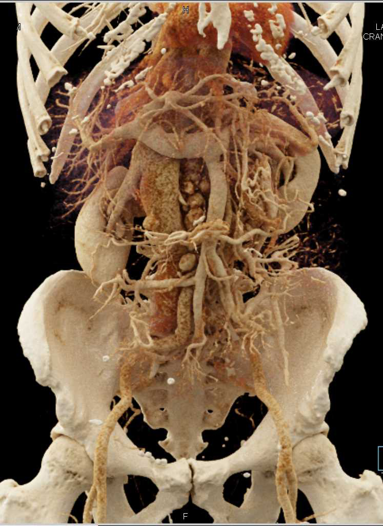 Extensive Para-Aortic Adenopathy with Cinematic Rendering - CTisus CT Scan