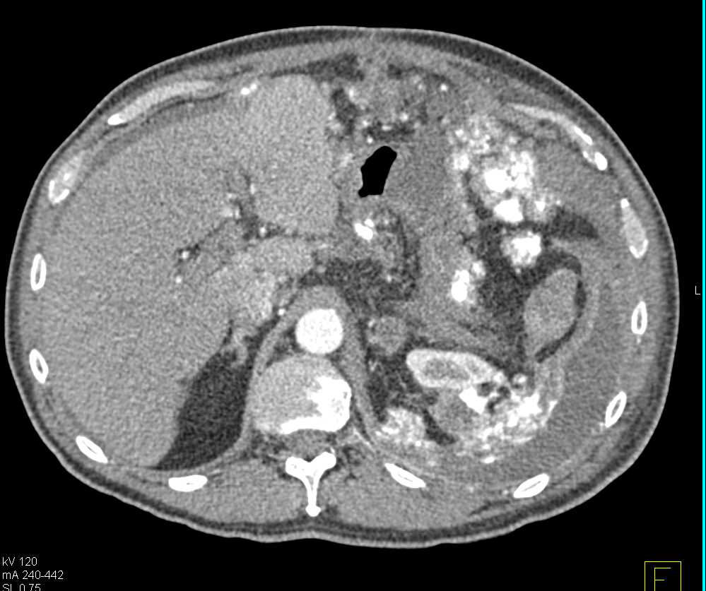 Mucinous Cystadenocarcinoma Metastatic to the Omentum - CTisus CT Scan