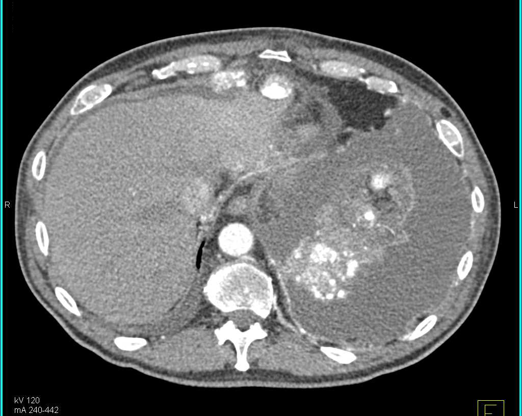 Mucinous Cystadenocarcinoma Metastatic to the Omentum - CTisus CT Scan