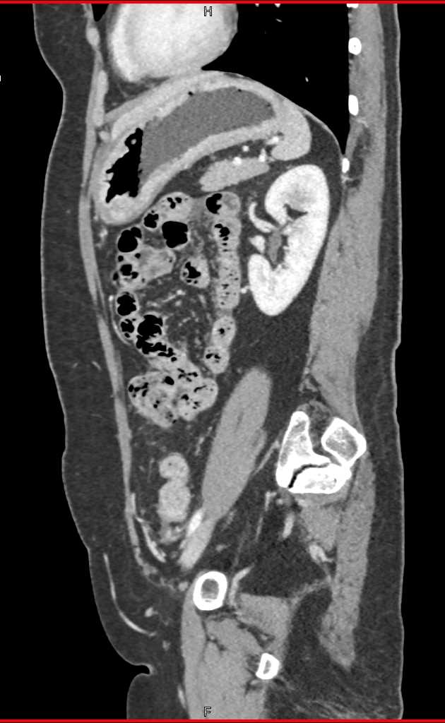 Carcinomatosis of the Abdomen - CTisus CT Scan