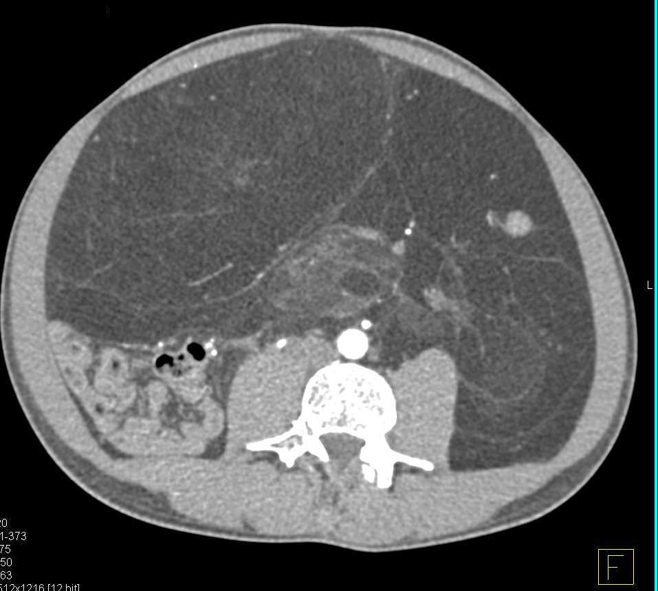 Retroperitoneal Liposarcoma - CTisus CT Scan