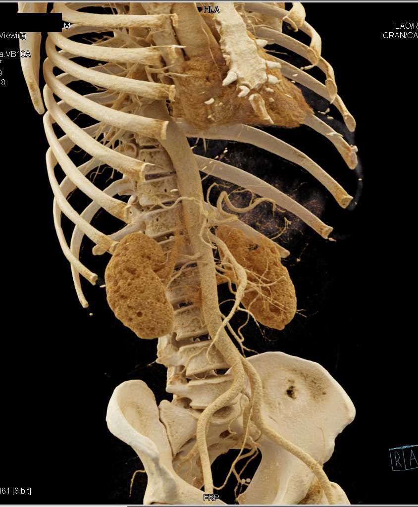 Musculoskeletal Anatomy of the Chest and Abdomen with Cinematic Rendering - CTisus CT Scan