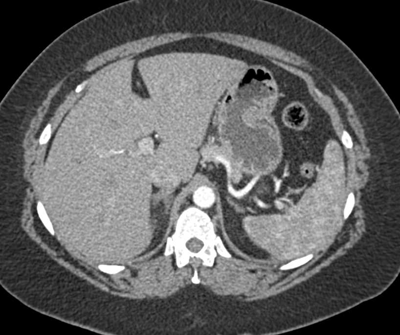 Schwannoma in the Right Para-Aortic Region - CTisus CT Scan