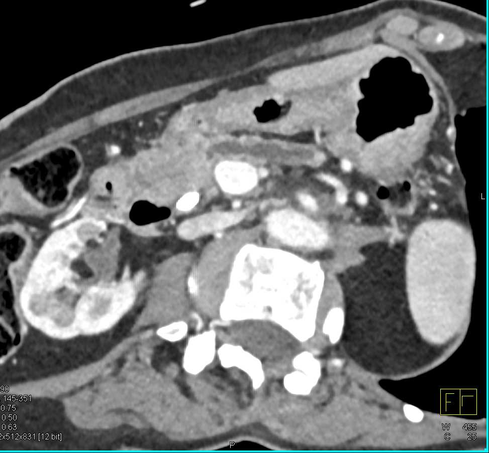 Esophageal and Pancreatic Cancer - CTisus CT Scan