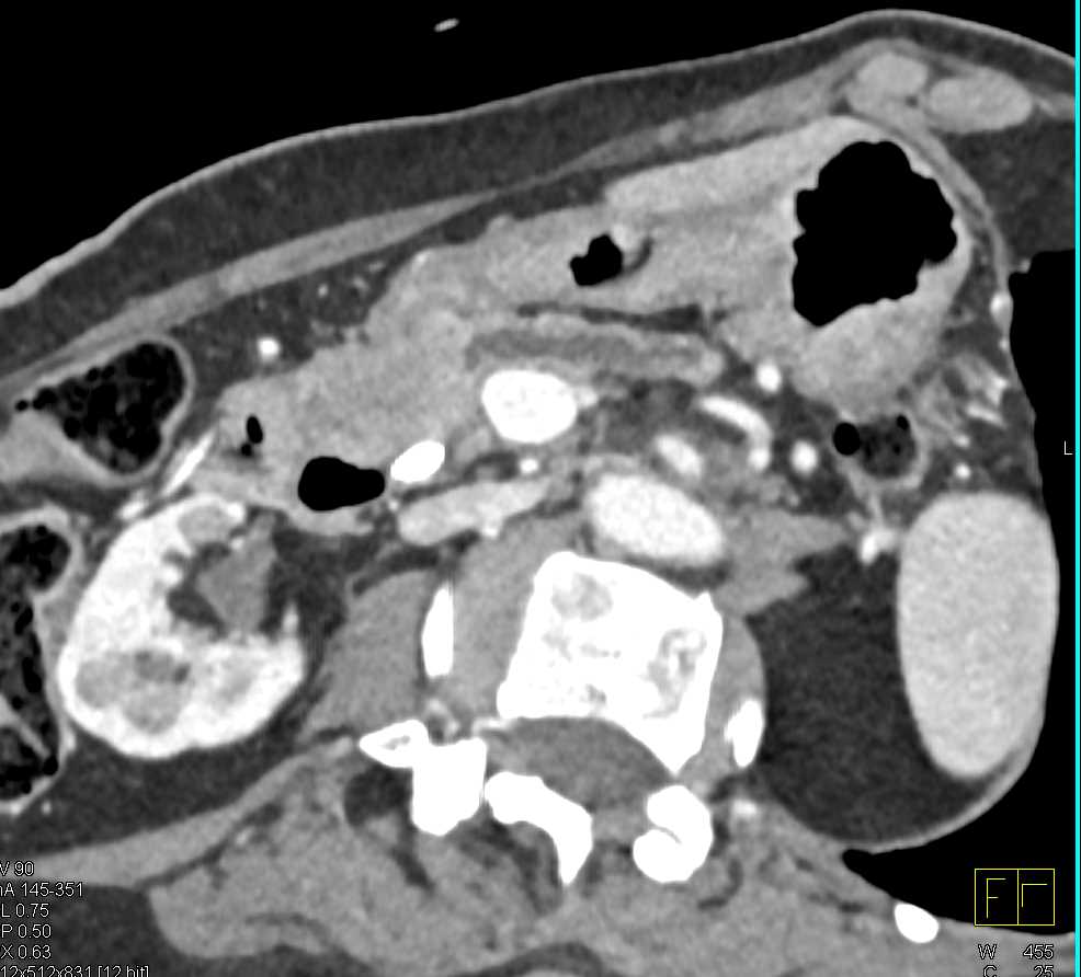 Esophageal and Pancreatic Cancer - CTisus CT Scan