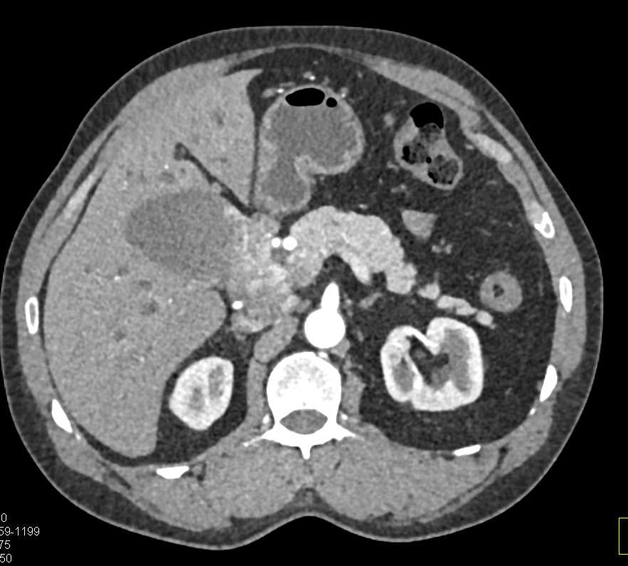 Invasive Gallbladder Cancer - CTisus CT Scan