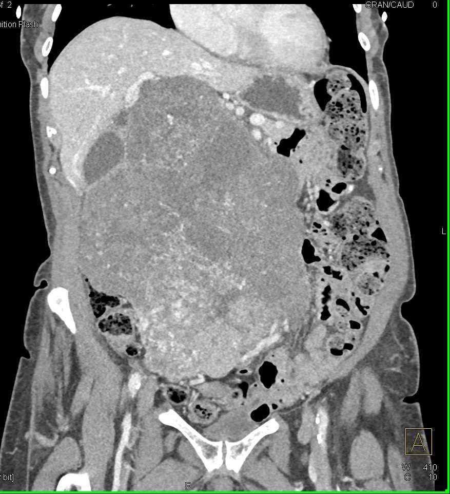 Retroperitoneal Liposarcoma - CTisus CT Scan
