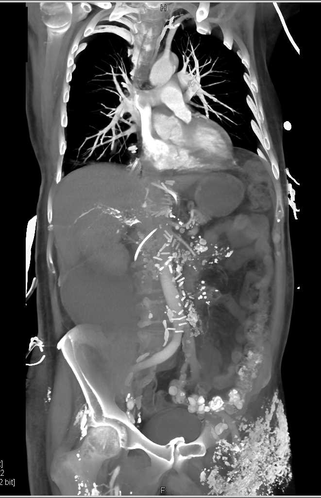 CT Post Lymphangiogram - CTisus CT Scan