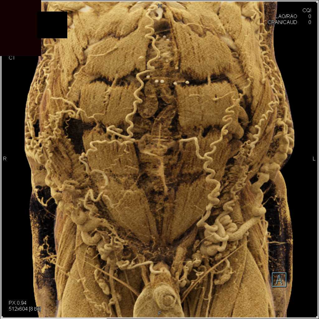 Prominent Collaterals in the Abdominal Wall - CTisus CT Scan