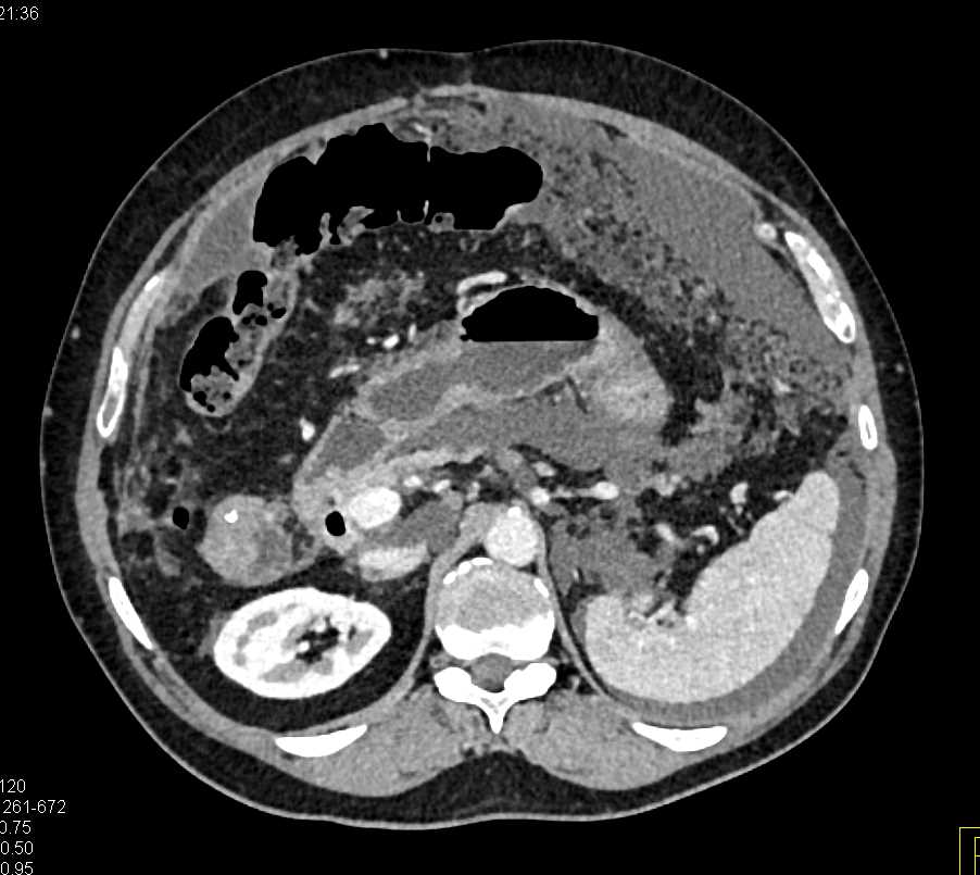 Carcinomatosis of the Abdomen - CTisus CT Scan