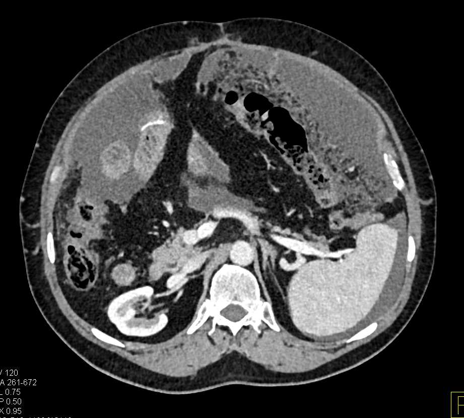Carcinomatosis of the Abdomen - CTisus CT Scan