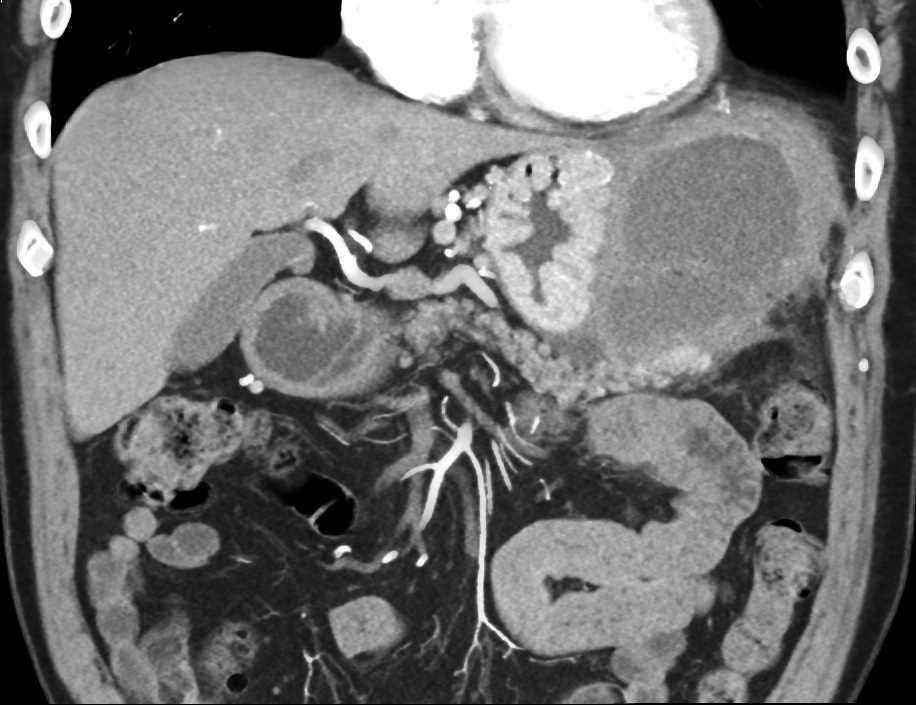Left Upper Quadrant Abscess Near the Spleen and Stomach - CTisus CT Scan