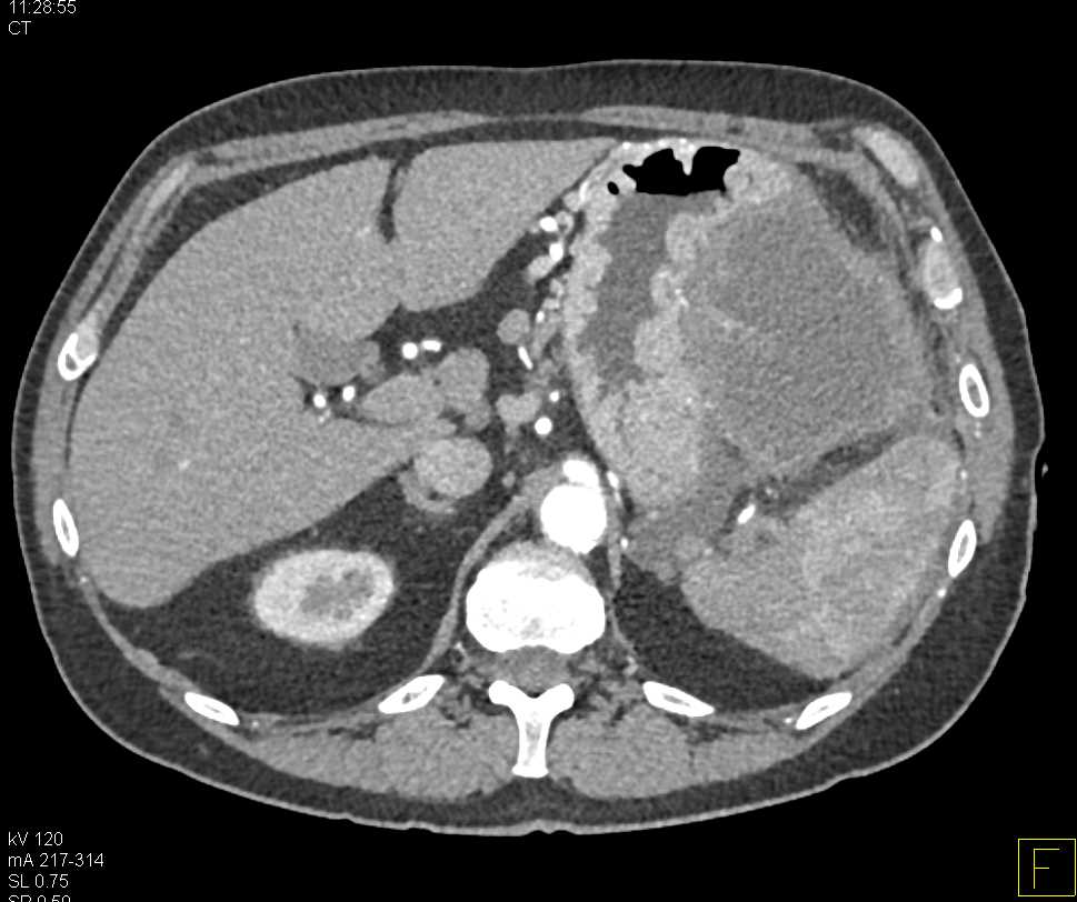 Left Upper Quadrant Abscess Near the Spleen and Stomach - CTisus CT Scan