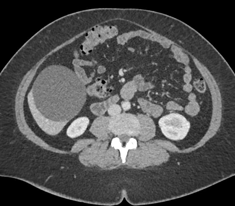 Mesenteric Cyst - CTisus CT Scan