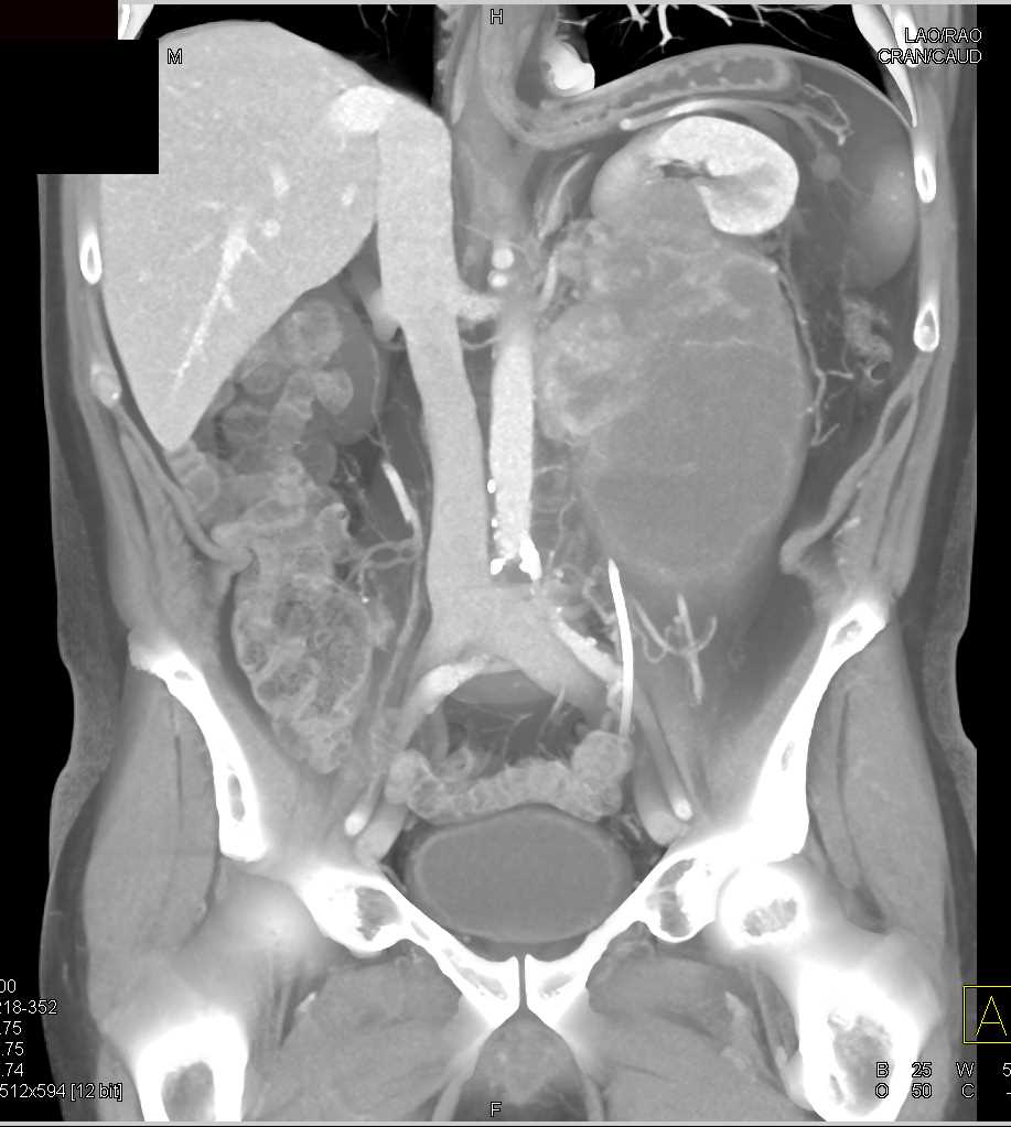 Retroperitoneal Sarcoma Displaces the Left Kidney - CTisus CT Scan