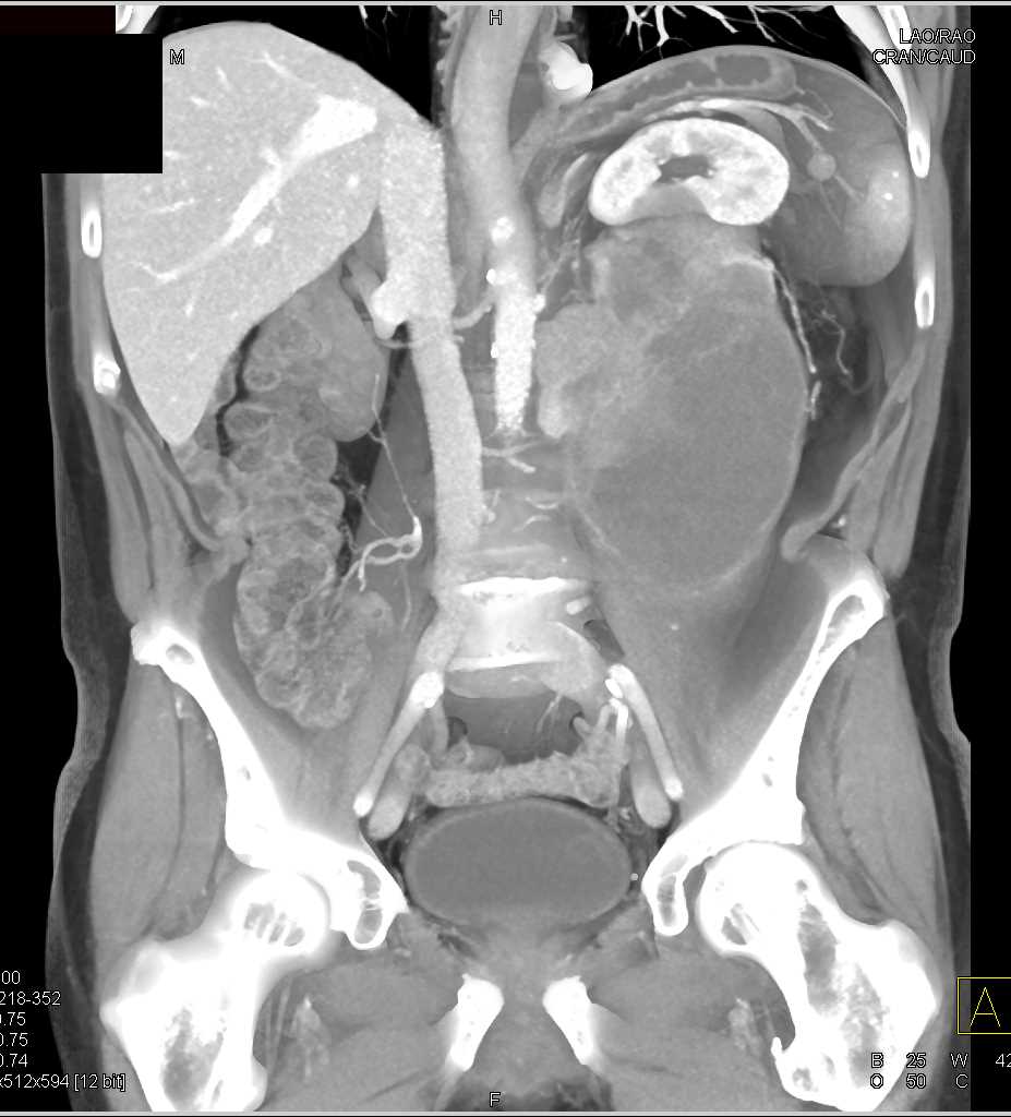Retroperitoneal Sarcoma Displaces the Left Kidney - CTisus CT Scan