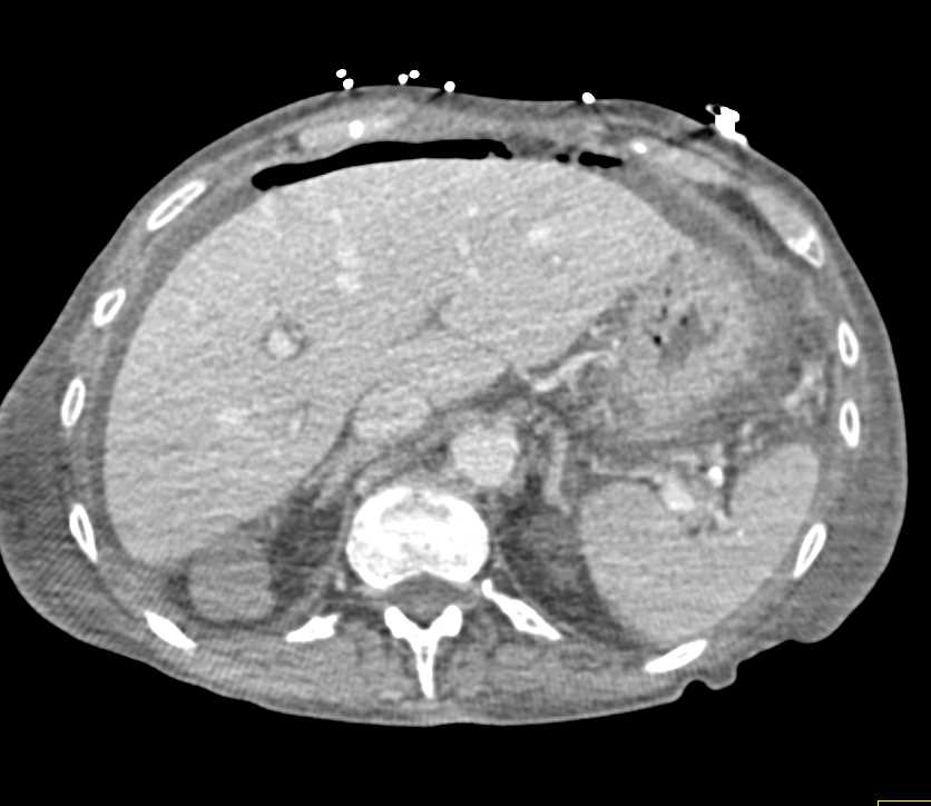 Pneumoperitoneum due to Perforated Gastric Ulcer - CTisus CT Scan