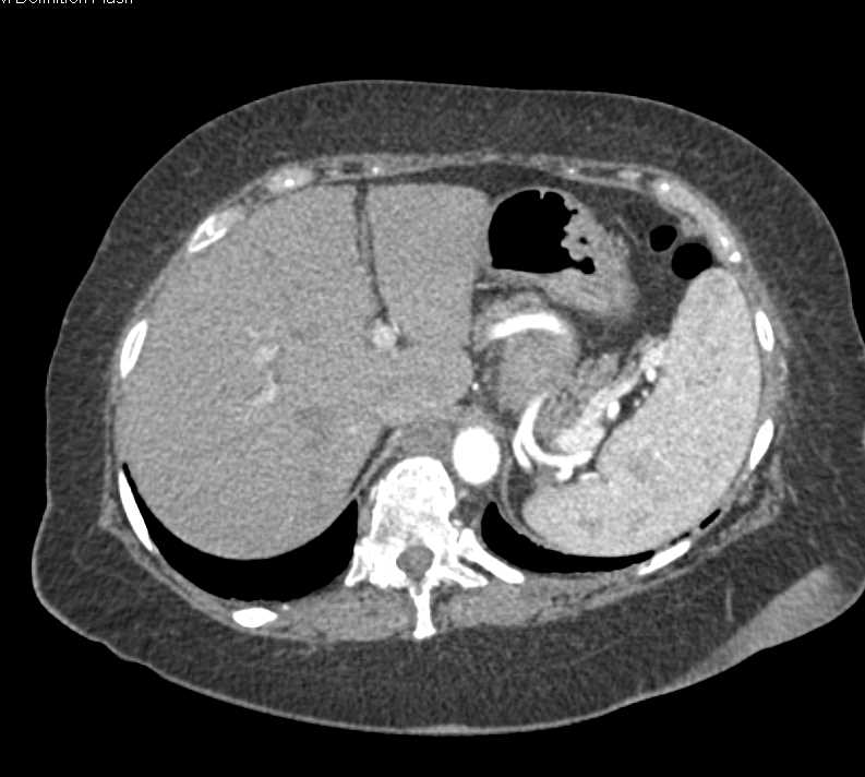 Para-aortic Adenopathy due to Lymphoma - CTisus CT Scan