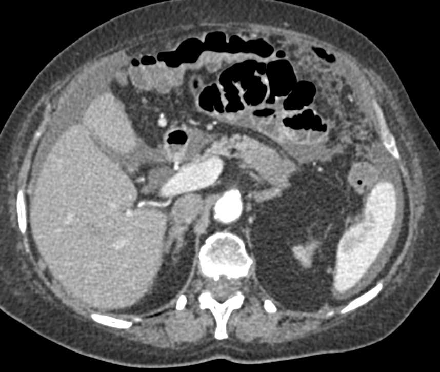 Carcinomatosis with Omental Implants - CTisus CT Scan