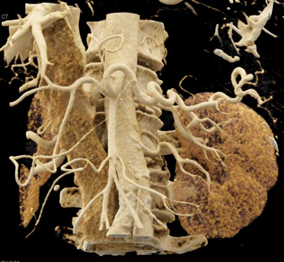 Vascular Mapping Celiac and Superior Mesenteric Artery (SMA) - CTisus CT Scan